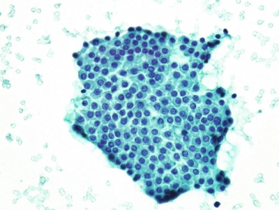 Benign follicular cells (macrofollicle fragment).
Keywords: Benign Follicular Cells, macrofollicle