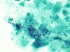 adenomatoid_nodule-Benign_follicular_cells_and_dense_colloid-pap-medium-_zhang.jpg