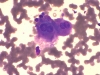 follicular_neoplasm_hurthle_cell_type-fu_hurthle_cell_adenoma-dq8-high-sturgis.jpg