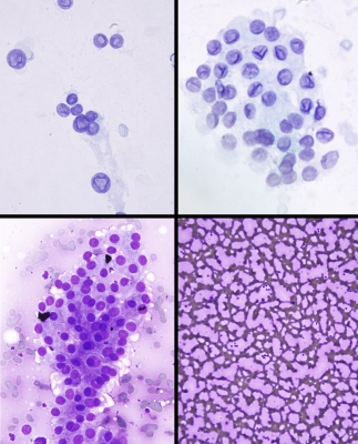 AUS/FLUS.
This was an extremely sparse sample. The upper two panels (Pap stain) show degenerated cells with questionable inclusions and grooves; the bottom two panels show fields that look like Graves' disease with flame cells and abundant colloid.
Keywords: Atypical AUS