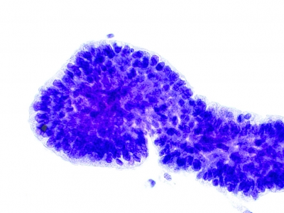 PTC, Columnar Cell Variant.
The cells are arrayed in a columnar ("picket fence") fashion along the edges of this crowded sheet.
Keywords: Papillary Carcinoma, liquid based, ThinPrep, Columnar Cell