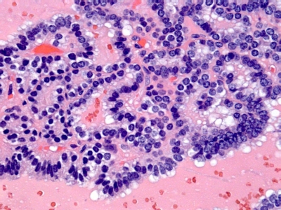 Papillary Carcinoma of Thyroid - Cystic Variant
Portion of a cystic papillary carcinoma from a cell block. Note the papillary material floating in loose colloid.
Keywords: Papillary Thyroid Carcinoma, Cystic Variant (PTC CV): 