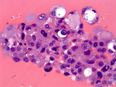Papillary Carcinoma of Thyroid - Cystic Variant
Cells from a cystic papillary carcinoma amid fluid in cell block. Note the small psammoma body in the center.
Keywords: Papillary Thyroid Carcinoma, Cystic Variant (PTC CV): 