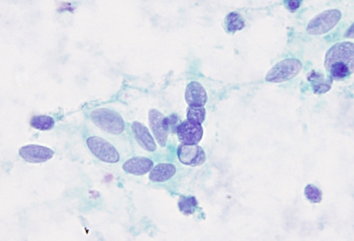 Pale nucleoplasm, oval shape, intranuclear pseudoinclusion (INCI), and nuclear groove.
Keywords: Papillary Carcinoma, Intranuclear Pseudoinclusion, groove