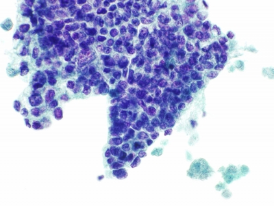 Metastatic esophageal adenocarcinoma (ThinPrep).
Keywords: Metastatic Esophageal Carcinoma, adenocarcinoma