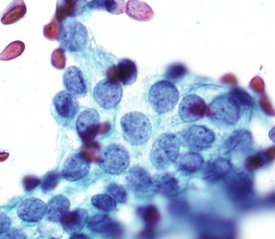 Papillary Carcinoma with powdery chromatin
Keywords: Papillary Carcinoma i powdery nuclei