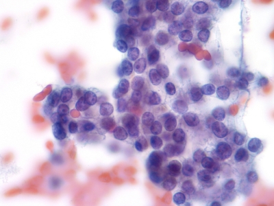 Papillary Carcinoma
Fine chromatin in the cells of papillary carcinoma.
Keywords: Papillary Carcinoma