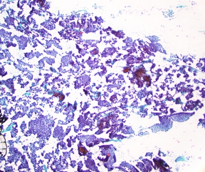 Papillary Carcinoma, low power
Highly cellular preparation in papillary carcinoma with sheets of tumor cells
Keywords: Papillary_Carcinoma  sheets Low_Power