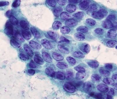 Papillary Carcinoma with Grooves and Nucleoli
Papillary carcinoma with elongated nuclei, occasional nuclear grooves and prominent nucleoli
Keywords: Papillary Carcinoma with nuclear grooves and nucleoli