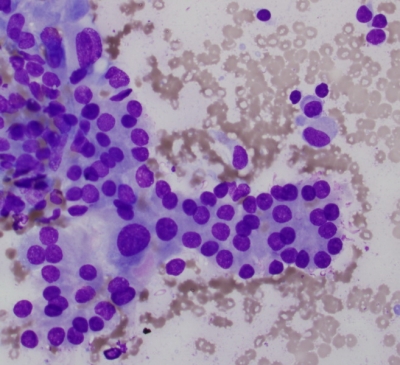 Hurthle cells with anisonucleosis.
Keywords: Chronic Lymphocytic Thyroiditis (Hashimoto)