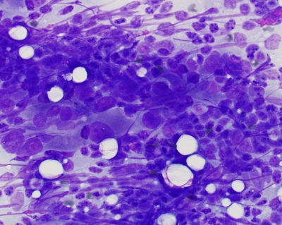 Polymorphous lymphoid population with crush artifact and few Hurthle cells.
Keywords: Chronic Lymphocytic Thyroiditis (Hashimoto) Oncocytes, Lymphocytes