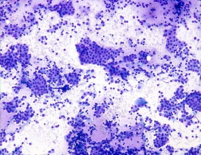 Graves Disease
Low power image of cellular sample in Graves Disease.
Keywords: Graves Disease
