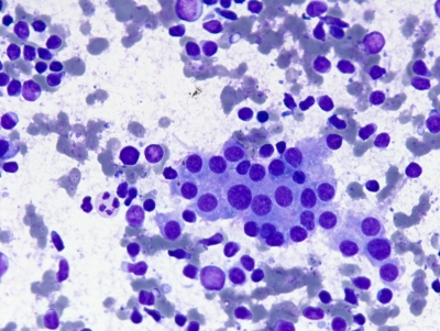 Polymorphous lymphocytes and Hurthle cells.
Keywords: Hashimoto, Autoimmune, Chronic Lymphocytic Thyroiditis