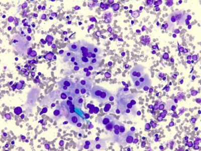 Hurthle cells (oncocytes) and lymphocytes.
Keywords: Hashimoto, Autoimmune, Chronic Lymphocytic Thyroiditis