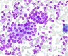Hashimotos,_follicular_cells_and_mixed_lymphoid_pop,_lp_SM__DQ.jpg