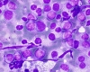 Thy_FNA_Plasmacytoid_B-cell_lymphoma2_DQ_SM.jpg